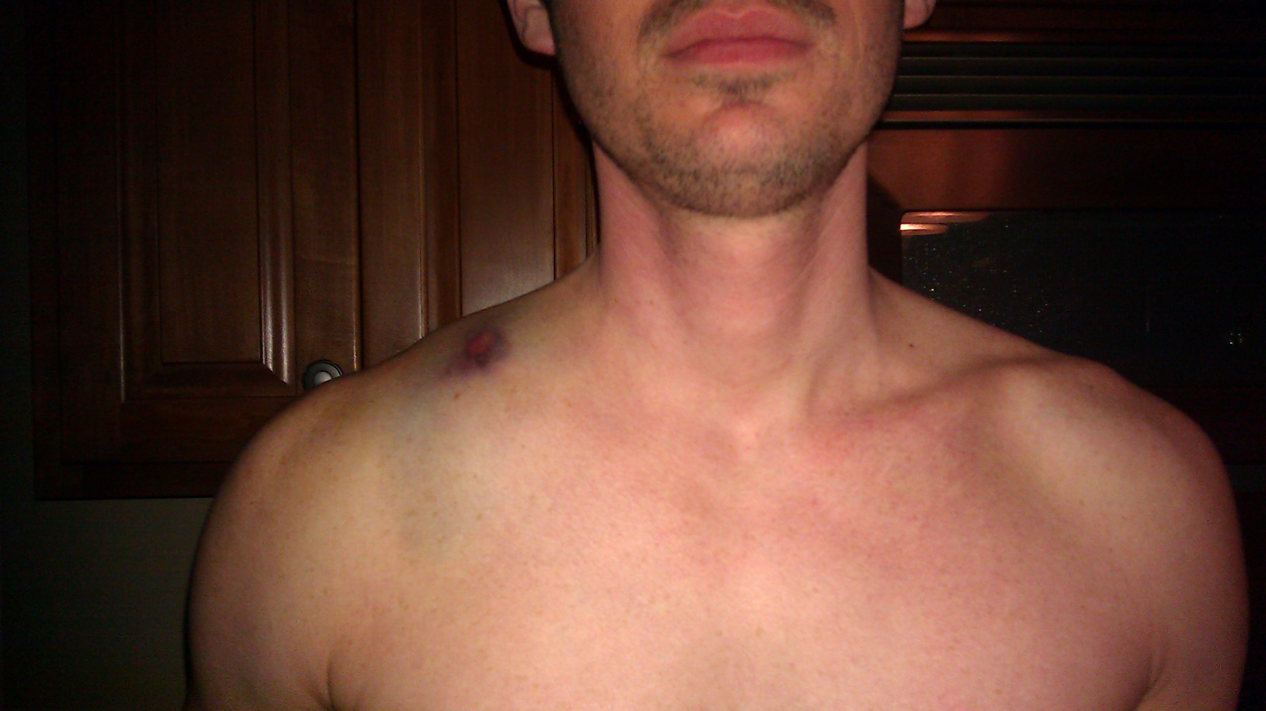 Chads Broken Clavicle A Magical Mess