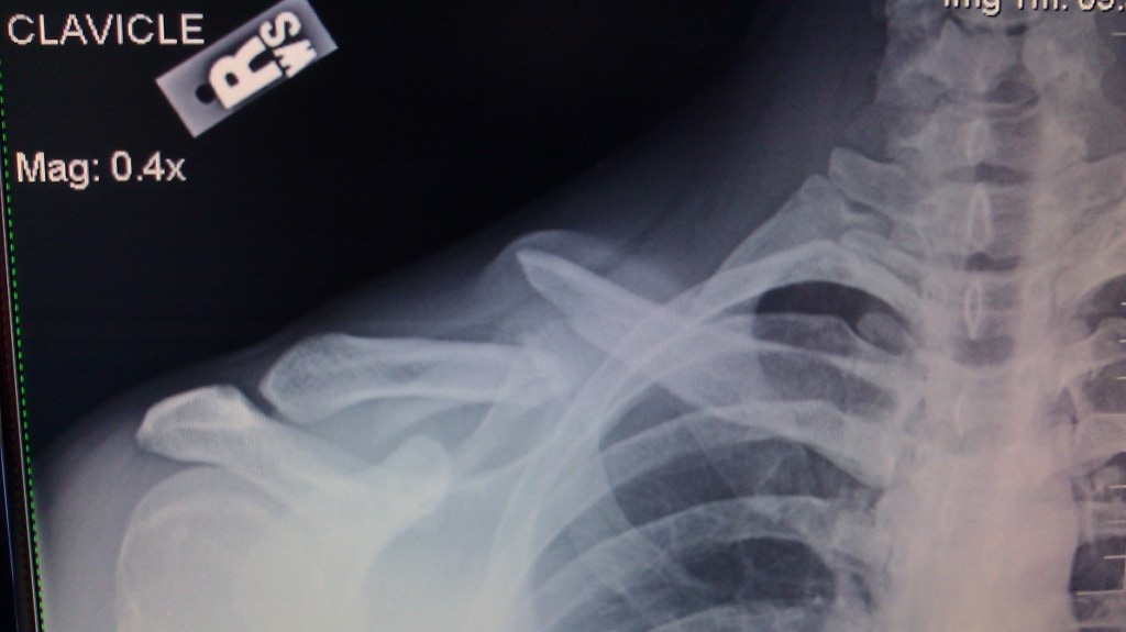 broken collar bone