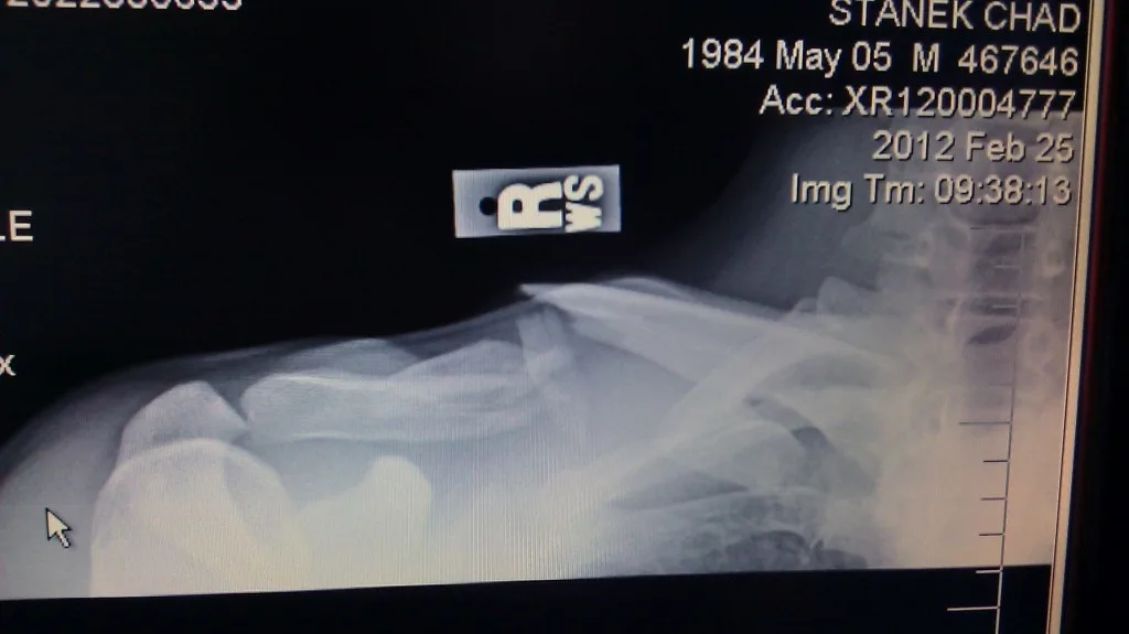 broken clavicle xray