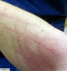 An arm with scratches on it. 