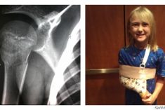 Poor Chesney's broken humerus