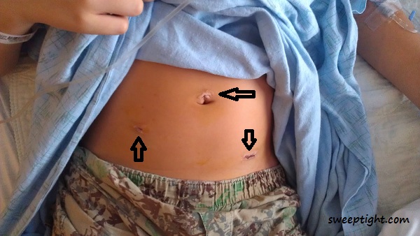 surgery surgical incisions