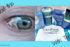 eye allergy chemosis