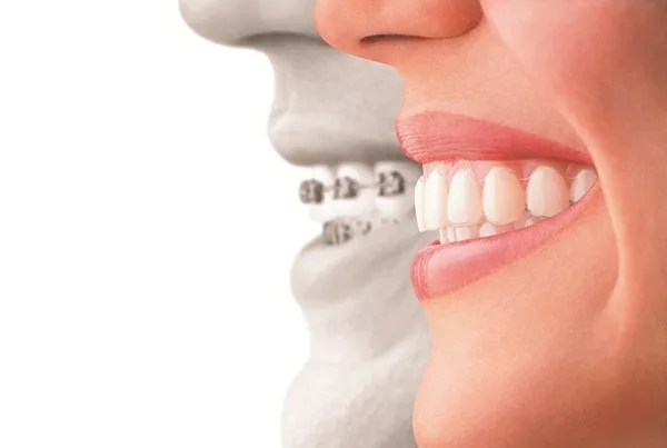 Braces compared to Invisalign.