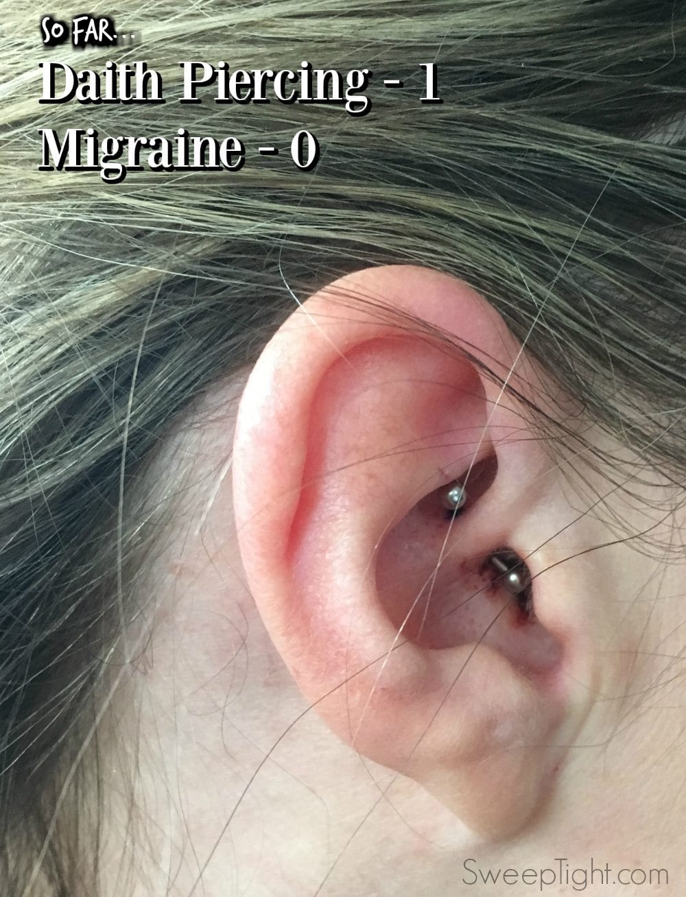 I tried a daith piercing for migraines. Check out my story!