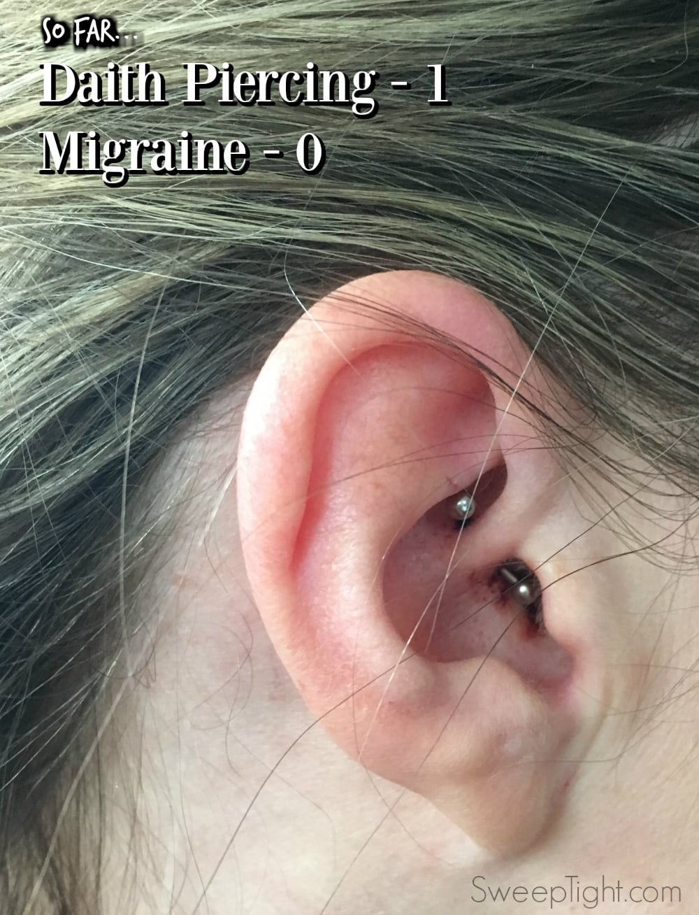 Trying Daith Piercing For Migraines After Years Of Pain