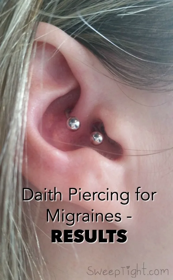 The ear piercing for migraines - results after 31 days