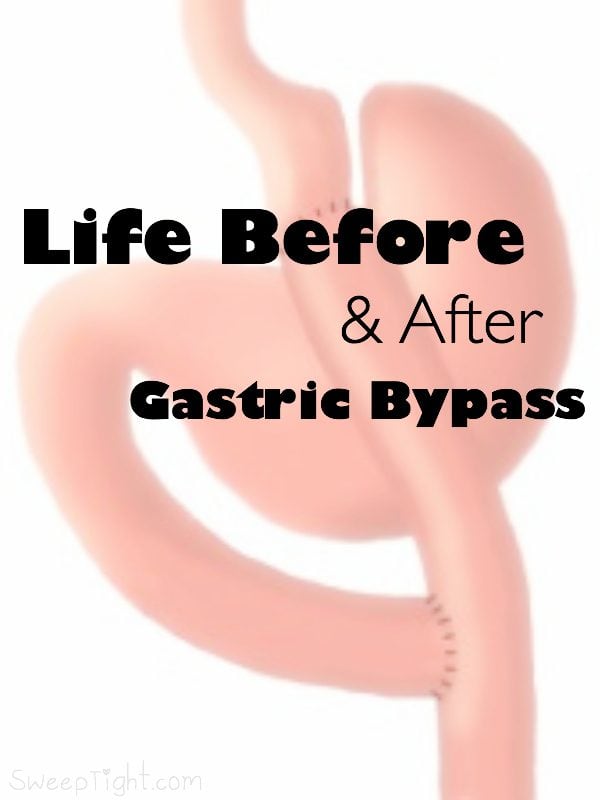 gastric bypass patient success story