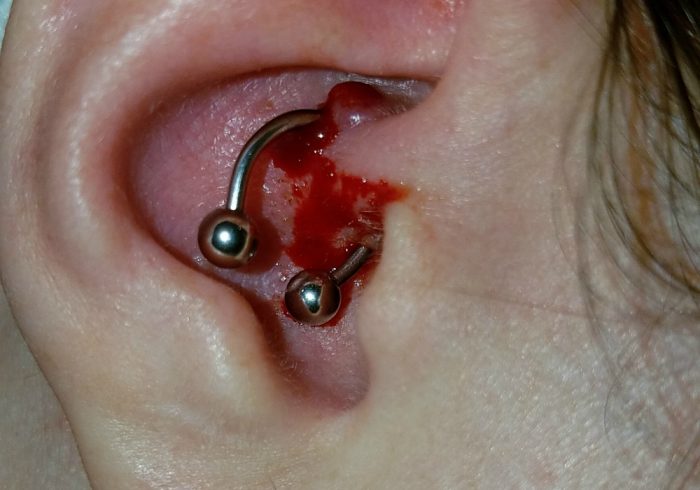 Bloody bubble at the site of a daith piercing in the ear