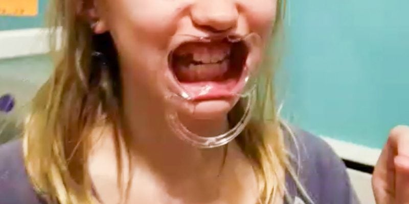 Teen with a Speak Out mouthpiece in.