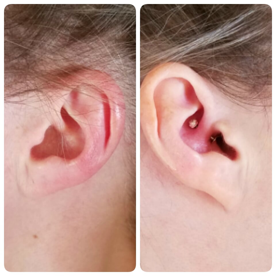 Migraine Piercing - 1 Year Results 