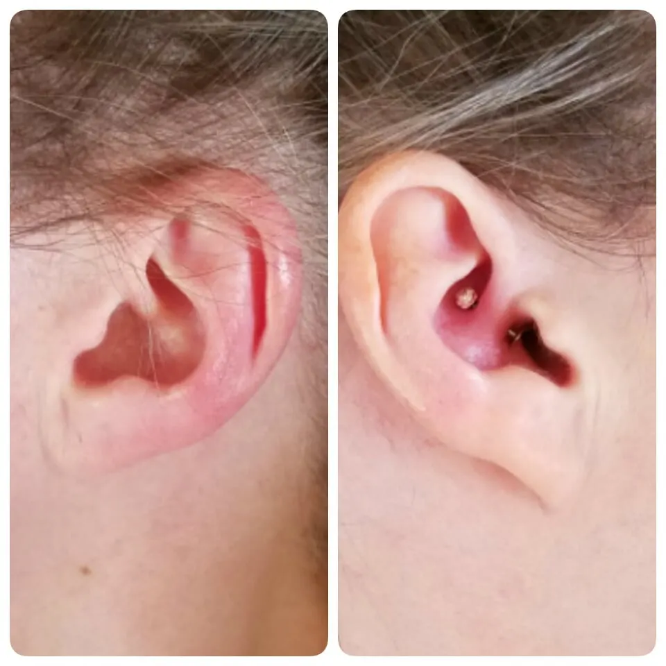 Ear with nothing and then an ear with jewelry in a pierced daith. 