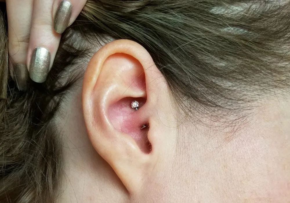 Migraine Piercing - 1 Year Results After Daith Piercing for Headaches