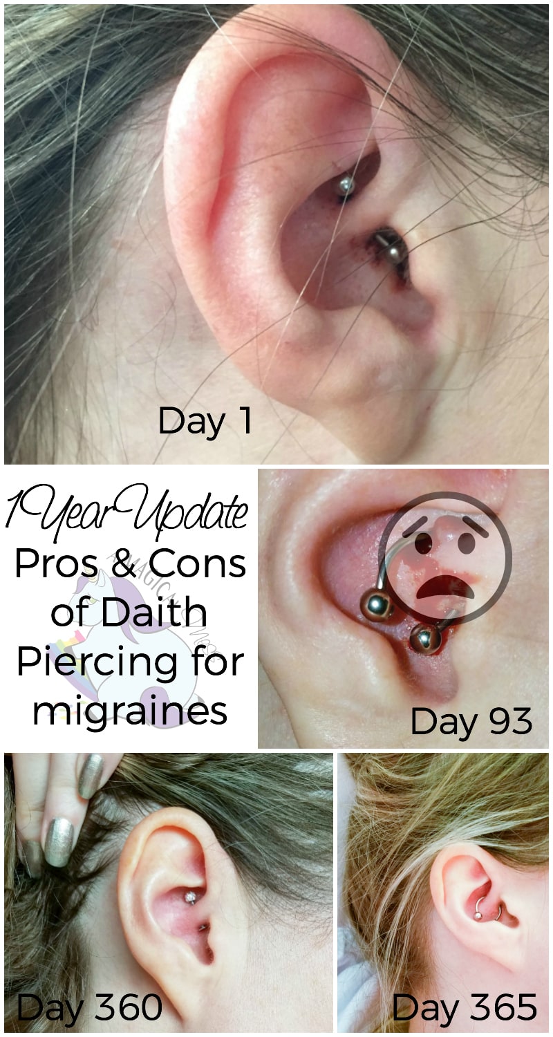 Migraine Piercing - 1 Year Results After Daith Piercing for Headaches