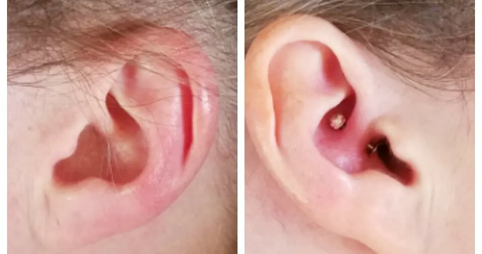 Daith Piercings for Migraines - FAQs What to do if your daith piercing gets infected...