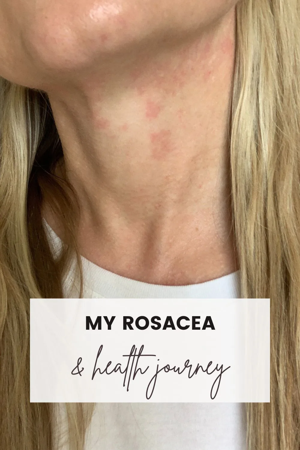 Flushed, hive neck inflamed from rosacea.