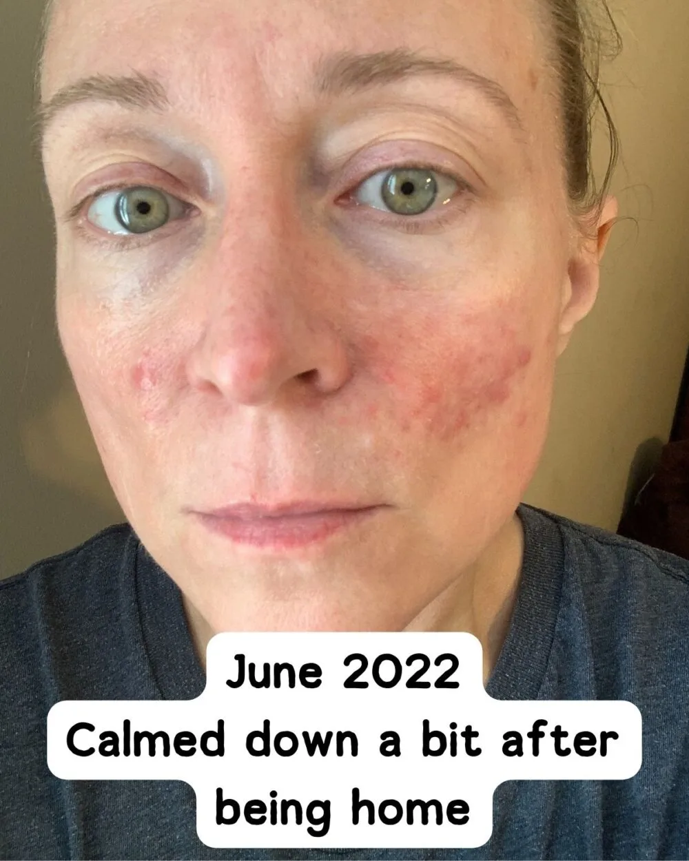 Rosacea skin after calming down a little. 