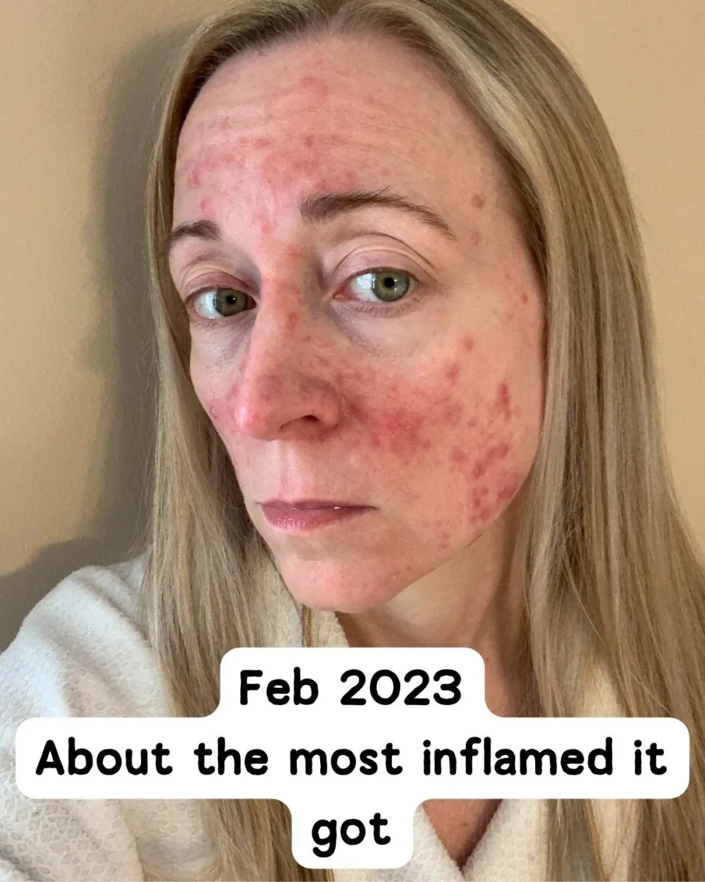 Severely inflamed acne rosacea. 