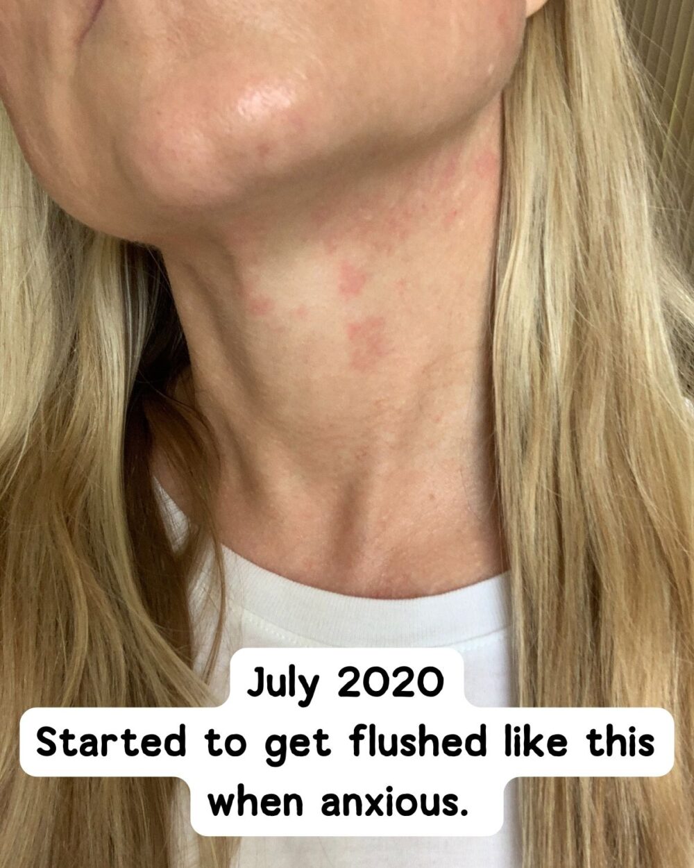 Flushed neck from rosacea or hives when nervous. 