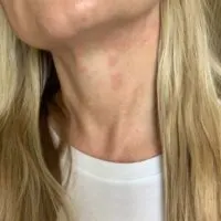 Neck flushed with hives or rosacea due to being nervous.
